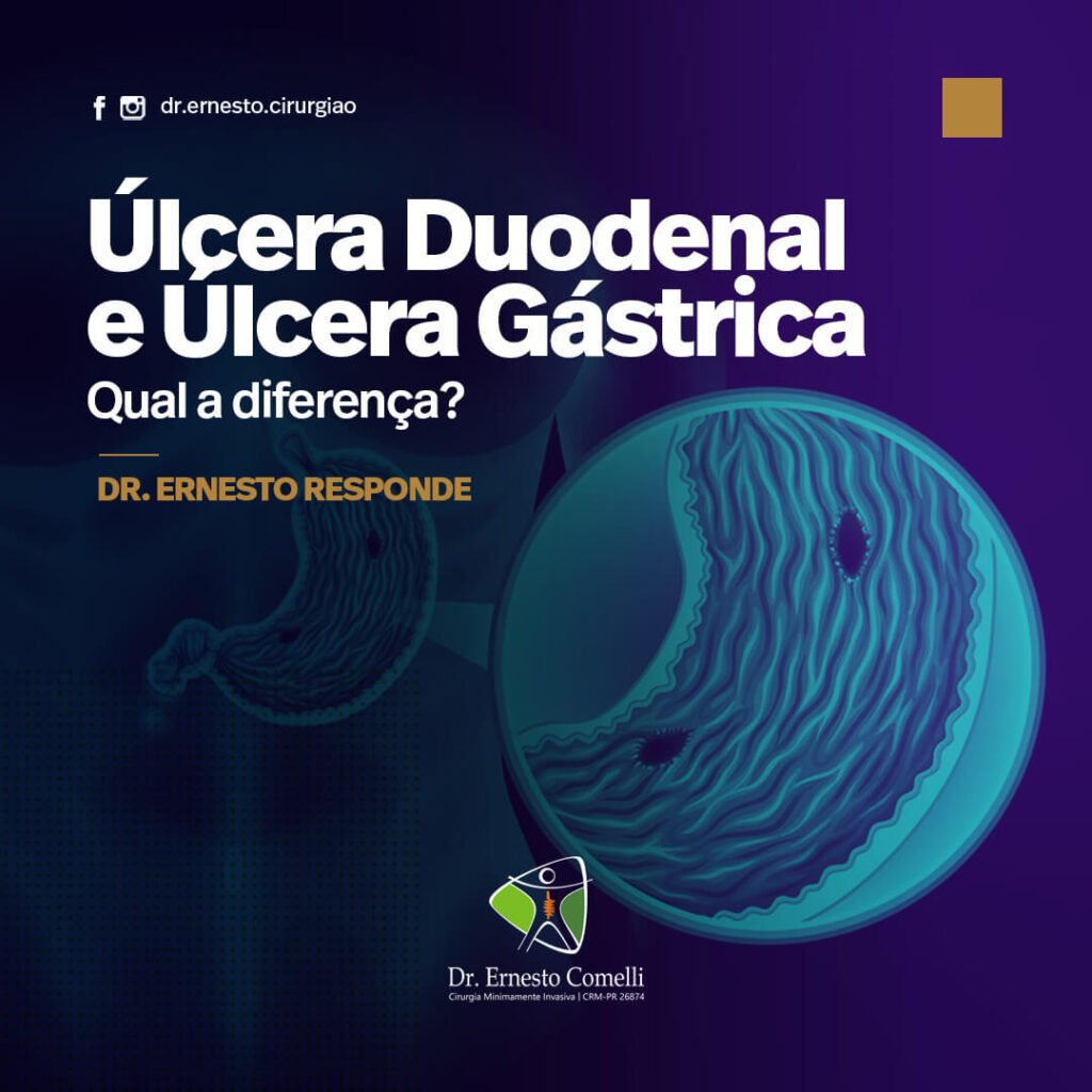 Lcera Duodenal E Lcera G Strica Qual A Diferen A Dr Ernesto Comelli