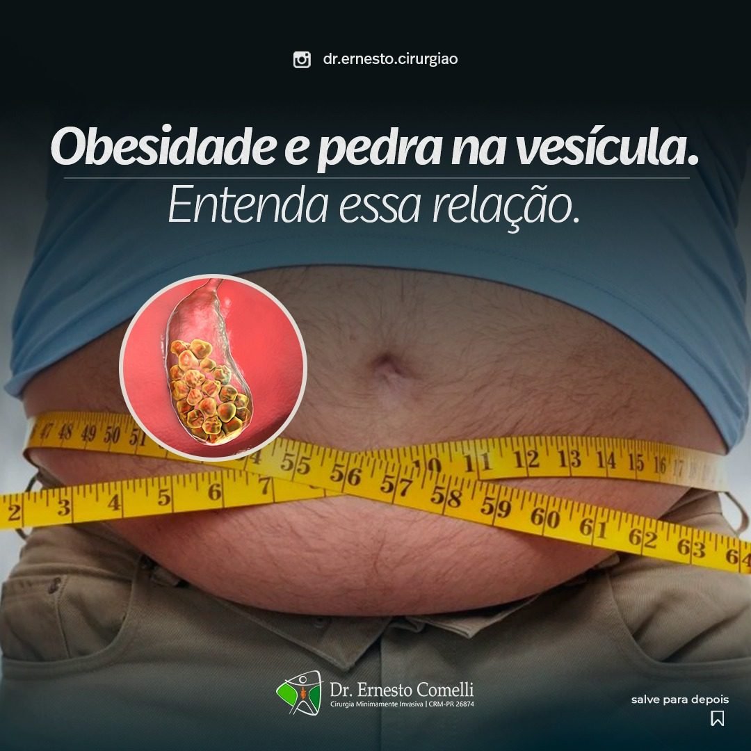 Obesidade e Pedra na vesícula Entenda essa relação Dr Ernesto Comelli